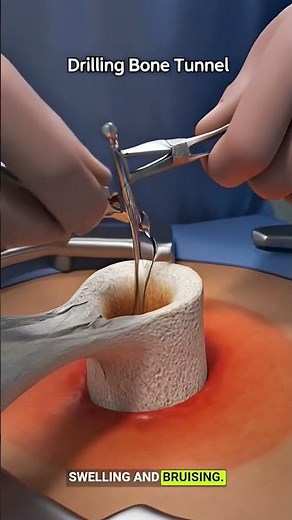 Distal Biceps Tendon Rupture & Repair | Anatomy, Injury, Surgery Explained