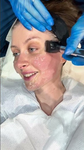 Watch a Forma Treatment | Radiofrequency Skin Tightening Explained