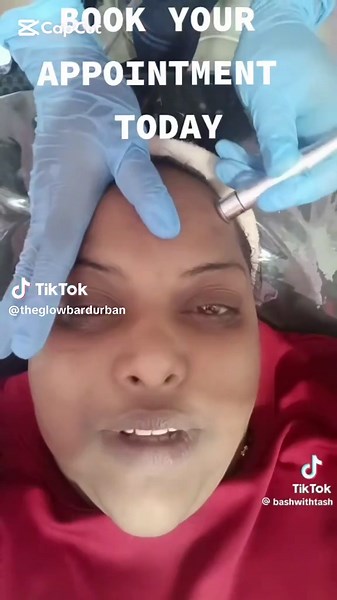 Microdermabrasion Treatment for Radiant Skin