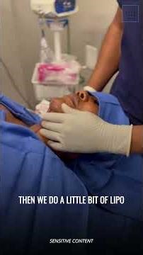 Awake Neck Liposuction
