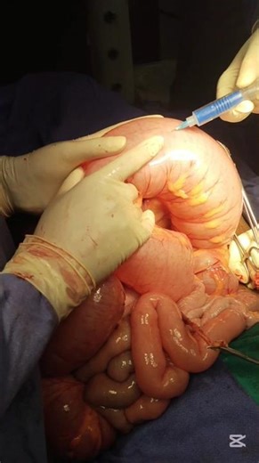 👉 Intestinal Obstruction Surgery Short⚕️ No graphic content is shown.📚 For educational use only.