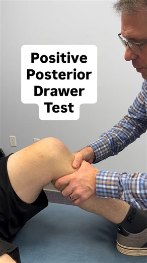 Paul Marquis on Instagram: "🔥Classic signs of a PCL tear! 👉 Positive brush test 👉 Positive posterior drawer test 👉 Positive sag sign 👉 Negative Lachman’ test 👉 Excess external tibial rotation #pcl #pcltear #kneeinjury #physicaltherapy #orthoevalpal #orthopedics #athletictraining #knee #kneepain"