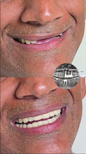 Front Tooth Implant Procedure | Missing Front Tooth Replacement | Dental Implant #smiledesigndental