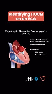 9.9K views · 54 reactions | Hypertrophic Obstructive Cardiomyopathy...