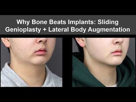 Why Bone Beats Implants: Sliding Genioplasty + Lateral Body Augmentation
