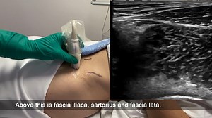 Fascia Iliaca Block