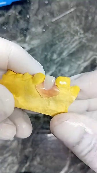 Removable prosthesis Clean finish – Proper retention Smile Makers Lab #dental #teeth #dentaltechnician #labwork