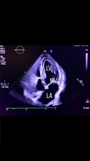 Apical 5 Chamber View #echocardiography #cardiology #echocardiogram