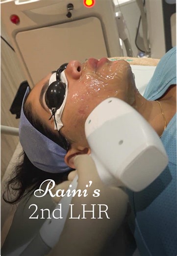 මෙහෙමයි Raini ගේ Laser Hair Reduction (LHR) – 2nd Session එක 360 Aesthetics Center එකෙන් කරගත්තේ ✨☘️ @𝐑𝐀𝐈𝐍𝐈 𝐂𝐇𝐀𝐑𝐔𝐊𝐀 Laser Hair Reduction කියන්නේ hair growth අඩු කරගන්න hair follicle එක directly target කරලා work කරන advanced treatment එකක්. @360aesthetics.sl @havelockcitymall Level 05 📍 Call Us at 0112 599 599 ‼️360aestheticscenter.com 360Aesthetic | Dr Cherry | Beauty Center | Sri Lanka | Colombo | Havelock City Mall | Microblading