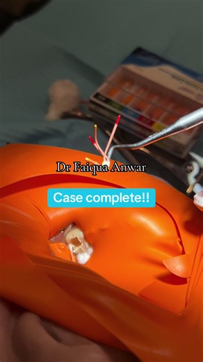 Successful Root Canal Treatment Completed!
