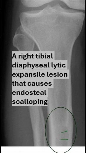 Tibial metaphyseal lytic lesion DD