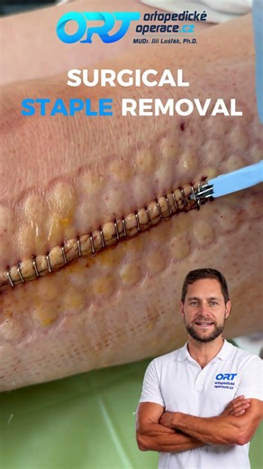 Surgical Staple Removal – Faster and Easier Than You Think! ✂️