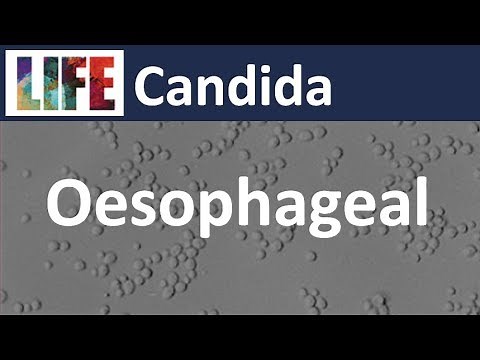 Oesophageal Candida