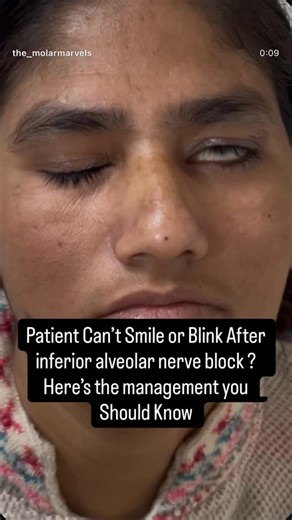 Dr adhya thakur arora on Instagram: "“If patient can’t blink after IAN block – it’s not stroke, it’s temporary facial nerve anesthesia After an IAN (Inferior Alveolar Nerve) block, if a patient can’t blink or smile, it’s usually due to temporary facial nerve involvement. Why does this happen? • During IAN block, if LA is deposited too posteriorly or enters the parotid gland • The facial nerve (CN VII) gets anesthetized • Result → transient facial nerve palsy Clinical features: • Inability to bli