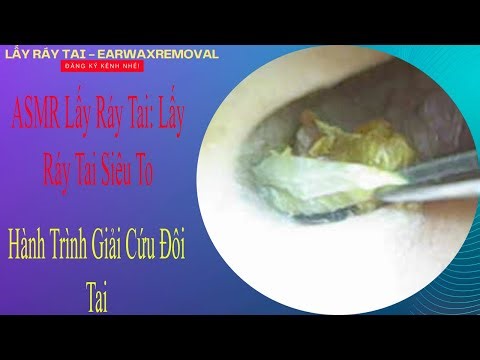 ASMR LẤY RÁY TAI: LẤY RÁY TAI SIÊU TO – HÀNH TRÌNH GIẢI CỨU ĐÔI TAI 😱