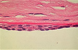 Posterior polymorphous corneal dystrophy - Alchetron, the free social encyclopedia