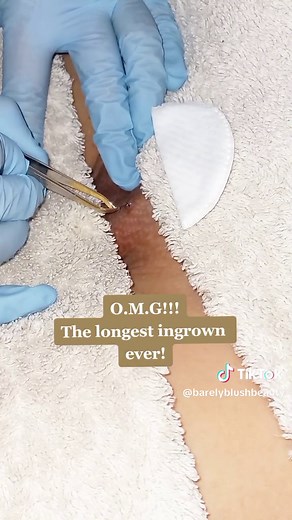 TW: Pubic area, hair removal, ingrown hair #hairremoval #ingrownhairremoval #fyp #fyppppppppppppppppppppppp #foryou #foryoupage #foru #hair #ingrowns #Hollywood #waxing #extraction #viral #trend