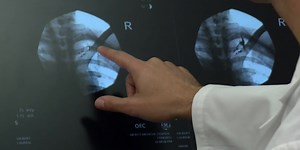 Pain persists for some patients after mastectomy or lumpectomy