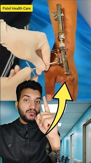 Fracture Care | External Fixation