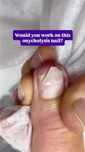 Severe Onycholysis | What Every Nail Tech Should Know #naileducation #nailtech #nailtechnology