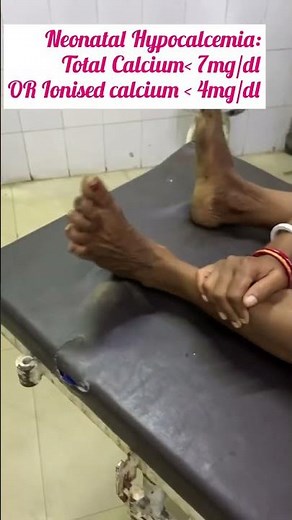 Classical Carpal spasm of Hypocalcemia.#medicalstudent