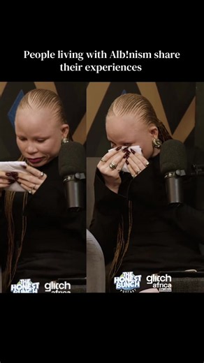 People Living with Albinism: Real Experiences and Challenges