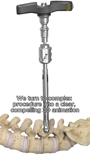 Percutaneous Pedicle Medical Animation - Pulse 3D Media