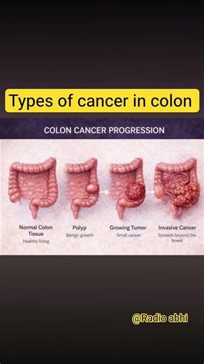 types of colon cancer ♋, human colon cancer type in body,how many types of colon cancer
