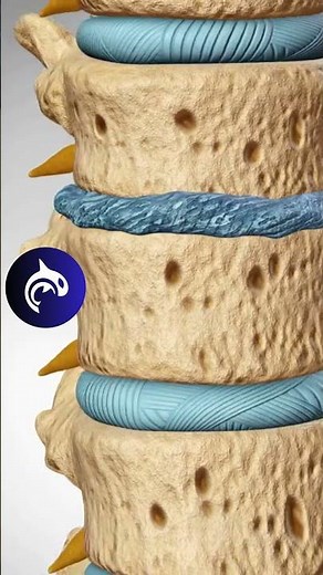 Degenerative Disc Disease - 4K 3D Animation
