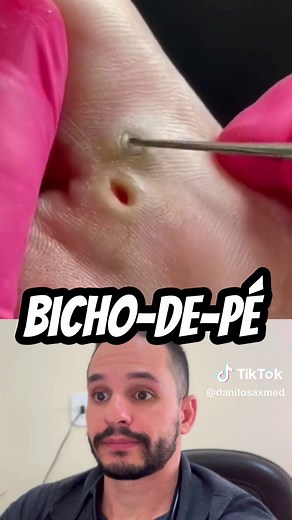 Bicho-de-pé: Causas, Sintomas e Tratamentos Eficazes