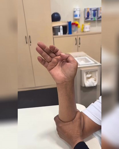 Hand recovery unlocked 👋✨ The team at Montefiore Rehab used the SaeboGlove to help their patient achieve improved hand opening, a key step toward functional independence. Proud of this progress! #SaeboGlove #NoPlateauInSight | Saebo, Inc.