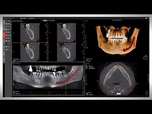 Osstem implant CBCT T1 3D Viewer OneClinic3D