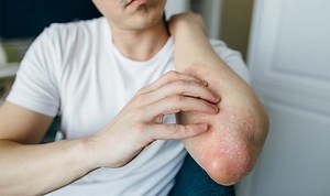 Eczema: Dermatology Nurse explains how to use emollients