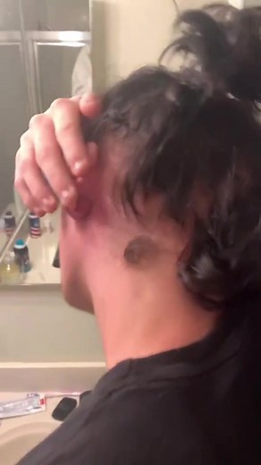 #stitch with @ngluugly #zit #boil #mukbang #fyp #foryou #foryoupage #MeLeaving #MicellarRewind #HalloweenIsHere #HeinzHalloween #yum #fypシ#MeLeaving