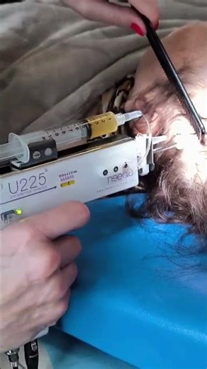 Redonnez de la force et de la densité à vos cheveux avec le PRP #shorts