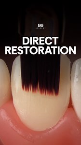 424K views · 1.3K reactions | Direct anterior restoration: step by step Want to master composite restorations? Join the BIG COMPOSITE & RUBBERDAM Course Date in English:  07-08 December, 2025 https://belograd.com/hands_on_course/big_composite_and_rubberdam_course/ Дата курса на русском:  24-25 Октября, 2025 https://belograd.com/ru/hands_on_course/po-kompozitam-rabberdamu/ | BeloGrad Academy | Facebook