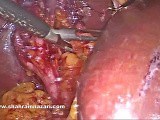 Laparoscopic Remnant Cholecystectomy for Calculi in the Remnant Gallbladder Following Subtotal Cholecystectomy • Video • MEDtube.net