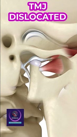 TMJ Dislocation Explained: Causes, Symptoms, and Treatment