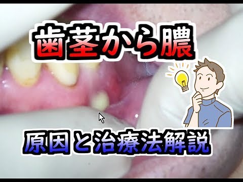 歯茎から膿、原因解説