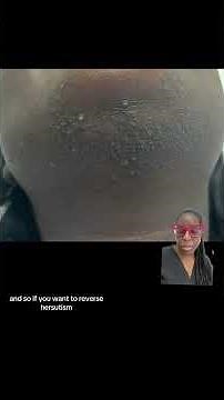 Stress and Food causes facial hair (PCOS Hirsutism)