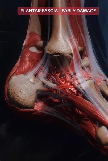 Plantar Fascia Micro-Tears: Understanding Early Damage
