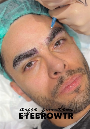 Eyebrow Transplant Journey in Turkey