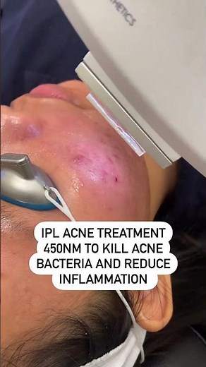 IPL Acne Treatment