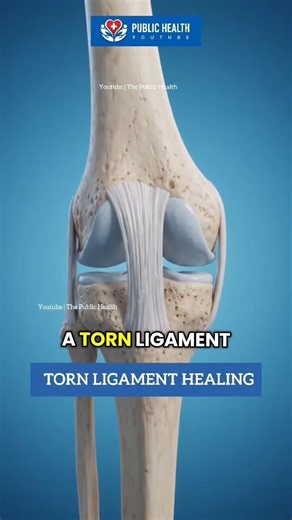How a Torn Ligament Heals | ACL Injury Explained #shorts #science #heals #3d #medical #medical