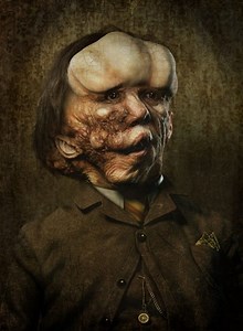 The Elephant Man, Joseph Merrick, and His Very Rare Disease