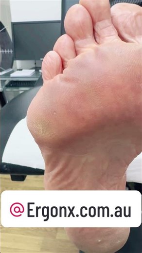 Ultimate Foot Transformation: Satisfying Callus Removal + Tips for Smooth Feet #FootCare #BeautyTips