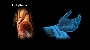 What is an Arrhythmia