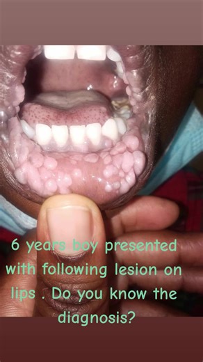 #lips #lesion #papular #diagnosis