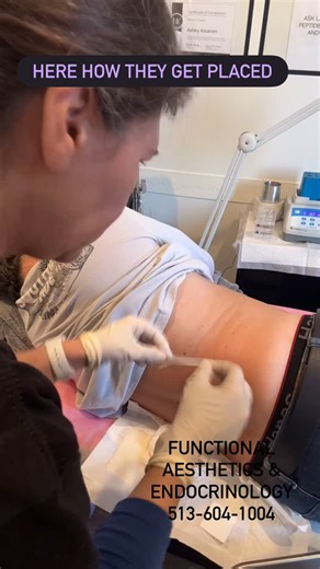 Naila Goldenberg on Instagram: "Hormonal pellets are form of hormone replacement Therapy- HRT. They have long history: 1930s: Pellets emerged in Europe, with U.S. endocrinologist Robert B. Greenblatt bringing the technique to America in 1939, often for women who had radical hysterectomies. 1940s-1950s: Pellet therapy was quite popular in the U.S. until pharmaceutical companies introduced synthetic hormones like Premarin (conjugated equine estrogens), which became more widely marketed. Continued 