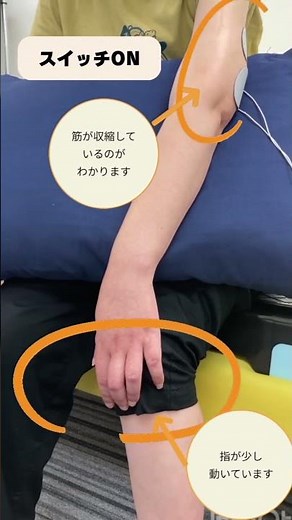 【脳梗塞リハビリ】低周波治療器を用いた手の自主トレ #作業療法士 #片麻痺 #リハビリ #miuリハ #脳梗塞リハビリ